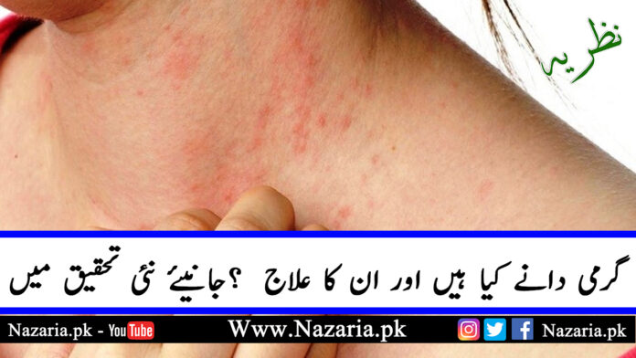 What is prickly heat and its Treatment. Nazaria.pk