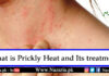 What is prickly heat and its Treatment, Nazaria.pk