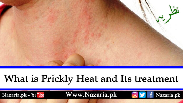 What is prickly heat and its Treatment, Nazaria.pk